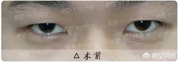 古巨基割双眼皮:对于男生割双眼皮你们怎么看