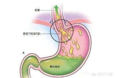 口水多是怎么回事:反流性食管炎会引起口水多吗？