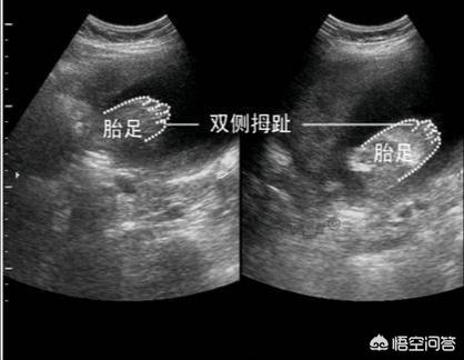 怀孕几个月能看出来畸形:胎儿几个月可以检查出畸形 怀孕多久后容易出现胎儿畸形？孕妈该如何预防？