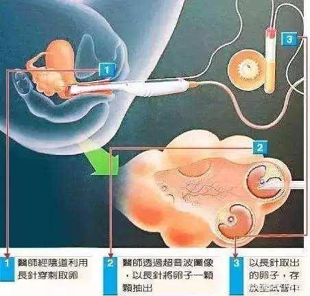 现在的试管婴儿成功率是不是普遍虚高？