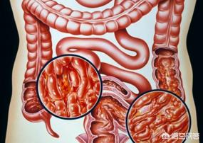 慢性肠炎的早期症状:慢性肠道炎早期症状有什么？