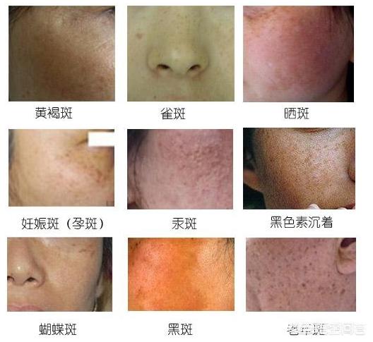 头条问答 - 脸部经常产生斑点,如何才能避免呢?(14个回答)