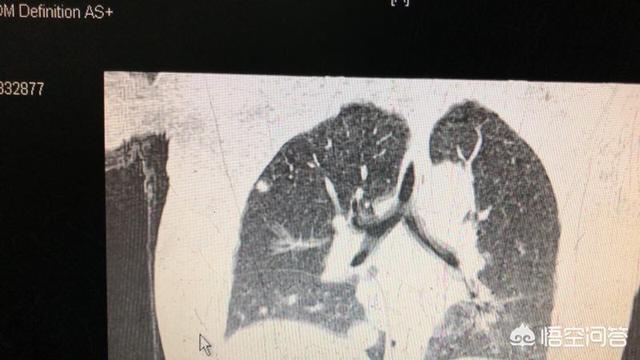 肺癌8x3cm严重吗：肺部结节8mmx6mm，严重吗？