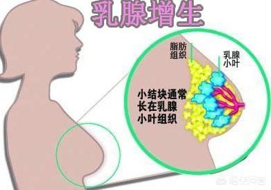 情志内伤:乳腺增生有不良反应吗？需要治疗吗？