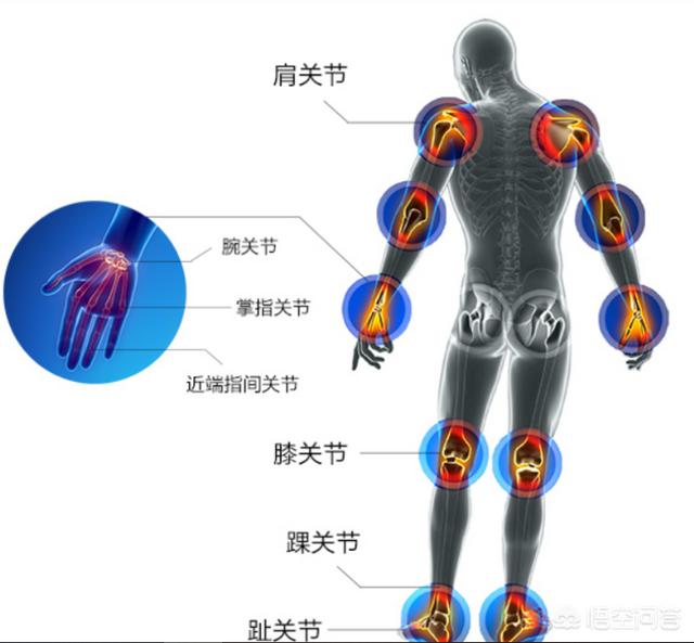 游走风湿关节炎能治好吗:游走性疼痛是什么病？该如何治疗？