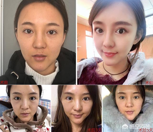 下睑下至导致睑外翻:下眼睑下至术哪些人群需要做？
