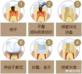 牙齿折断牙根还有用吗:牙齿断了一大半，还有办法修复吗？