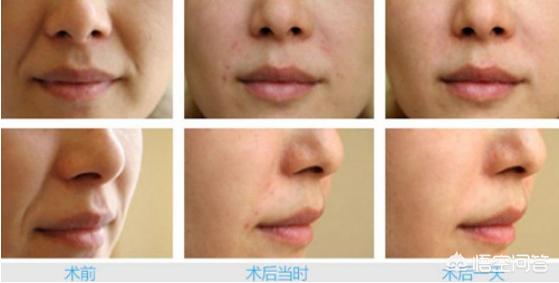 蛋白埋线提升对比图?蛋白埋线提升效果不同原因？