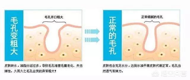 脸颊毛孔大怎么办(脸颊毛孔大里面有黑头怎么办)