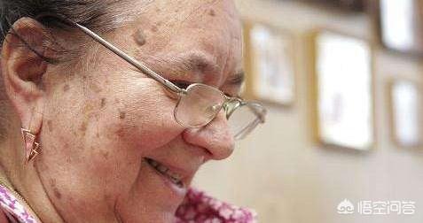 雀斑和黄褐斑:女性长黄褐斑一般和哪些病有关系