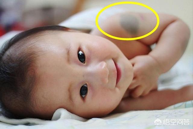宝宝的胎记跟妈妈有关系吗，胎记是天生遗传的还是后天形成的