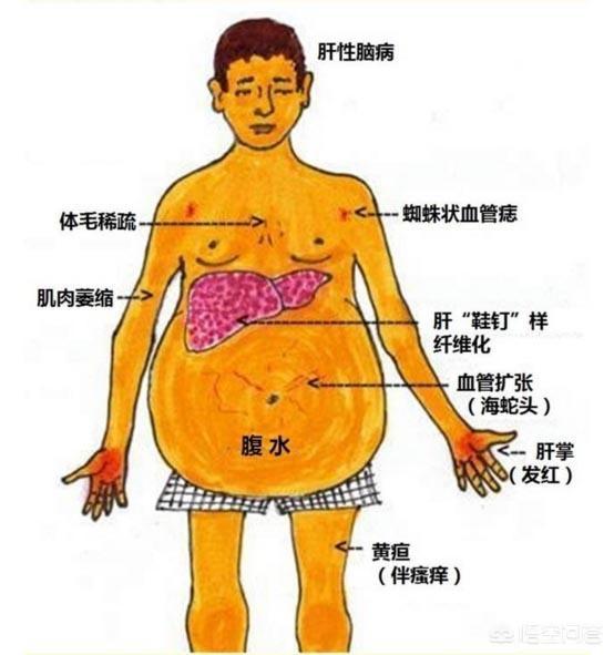 肝硬化呕血便血的原因:肝硬化患者出现呕血便血的原因 出现肝硬化的“8大征兆”是什么？