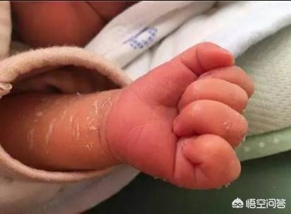 新生儿脱皮有哪两种原因，新生儿身上有褪皮怎么回事