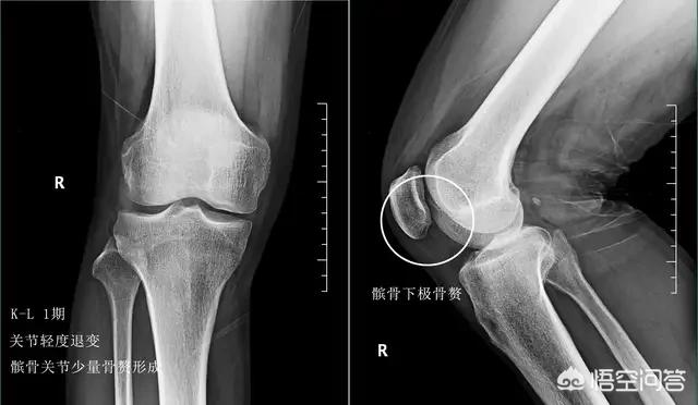 膝盖关节炎症状:膝关节痛是怎么回事？如何预防膝关节炎损伤疼痛？