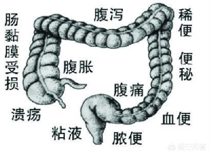 慢性肠炎的早期症状:慢性肠道炎早期症状有什么？