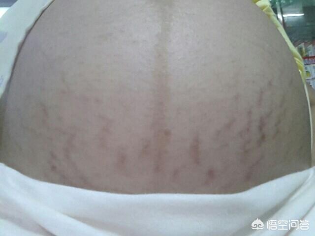 怀孕多久会长妊娠纹？为什么会长妊娠纹？插图47