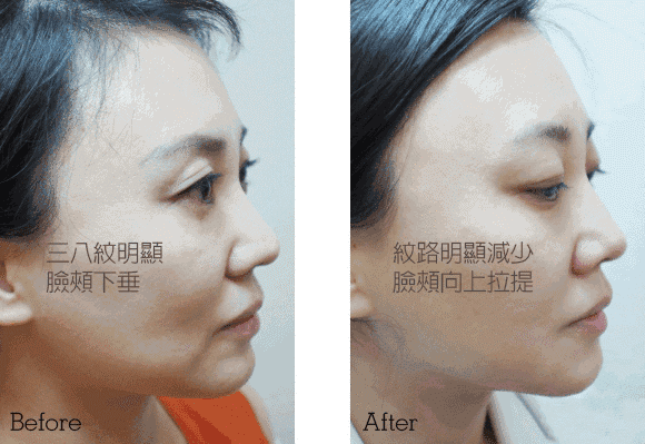 脸部护理仪器拆解:脸部清洁仪器拆解 线雕一星期可以贴面膜吗？