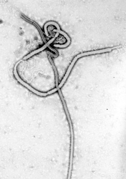 埃博拉病毒病人图片?埃博拉病毒病人图片似僵尸