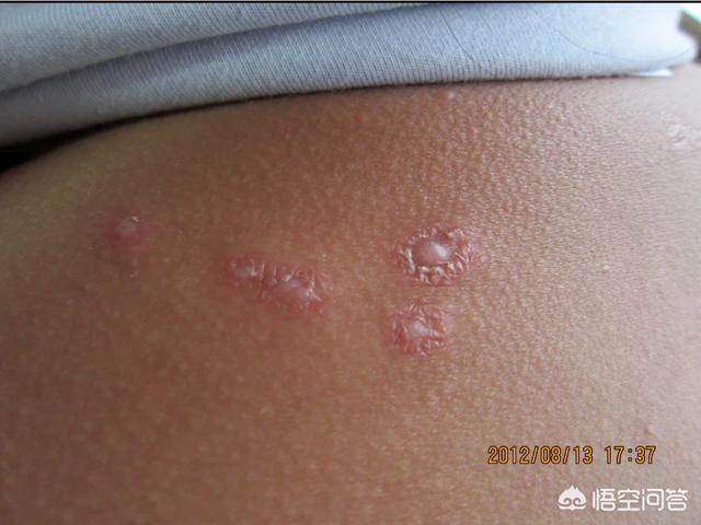 缠腰蛇怎么治好得快蛇缠腰图片早期症状