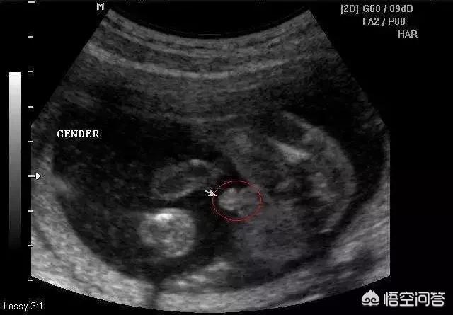 已经有了孕囊,孕囊里是否出现卵黄囊,胎芽;是否存在宫外孕,葡萄胎等