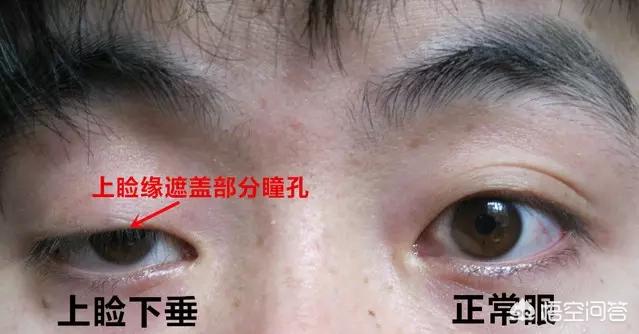 古巨基割双眼皮:对于男生割双眼皮你们怎么看