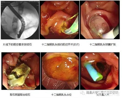 胆总管结石的症状是什么:大家对胆管结石了解多少？得了这个病治疗有什么好的建议吗？