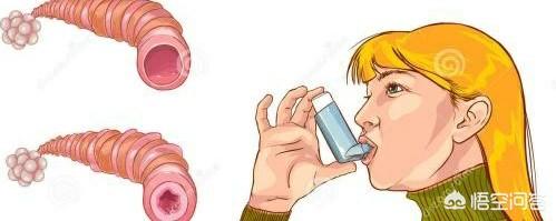 过敏性哮喘如何治疗(过敏哮喘治疗方法)