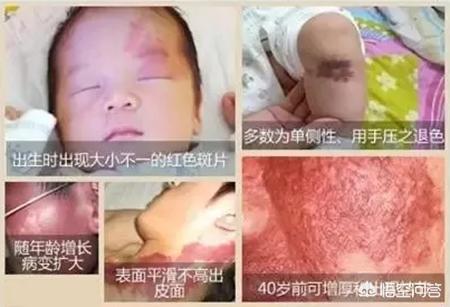 新生儿常见皮肤疾病图片:新生儿红斑和鲜红斑痣你分得清吗？