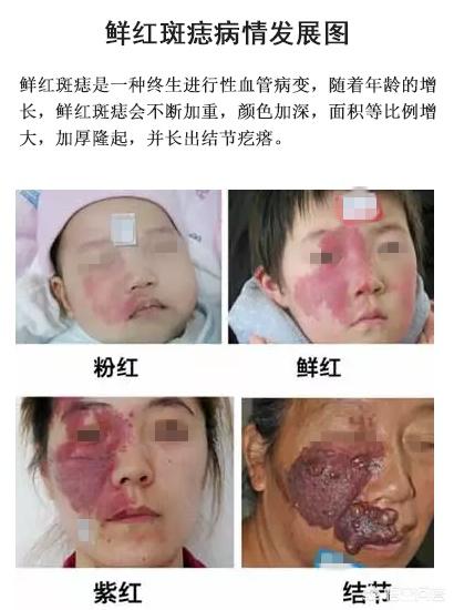 新生儿常见皮肤疾病图片:新生儿红斑和鲜红斑痣你分得清吗？