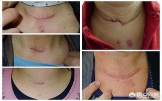 甲状腺手术有哪些后期影响