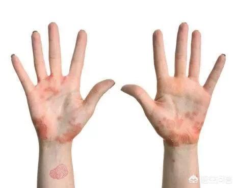 皮肤上的糖尿病信号是什么？-文史大世界的回答-头条问答