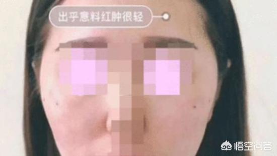 脸部护理仪器拆解:脸部清洁仪器拆解 线雕一星期可以贴面膜吗？