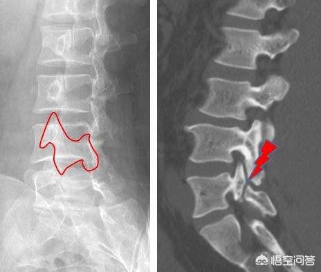 间歇性跛行:间歇性跛行见于什么病 腰间盘突出后可以引发别的什么症状？