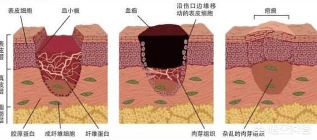 头条问答 手术伤口感染愈合后周围皮肤一直有刺痛感 可能破坏了周围神经 能治愈吗 小儿外科庞军良的回答 0赞