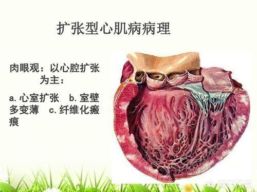 扩张型心肌病的病程:扩张型心肌病的病程记录 扩张性心肌病是不是很严重？医生说只能活3-5年是真的吗？