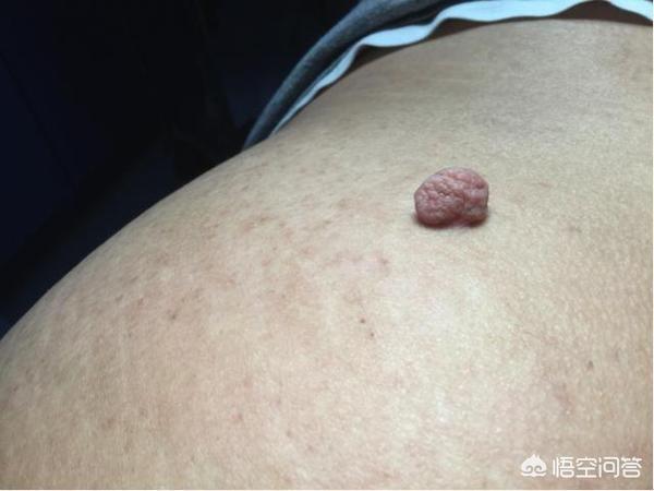身上长肉瘤:身上长肉瘤不痛不痒是怎么回事 身上长小肉团是怎么回事？是不是癌症？