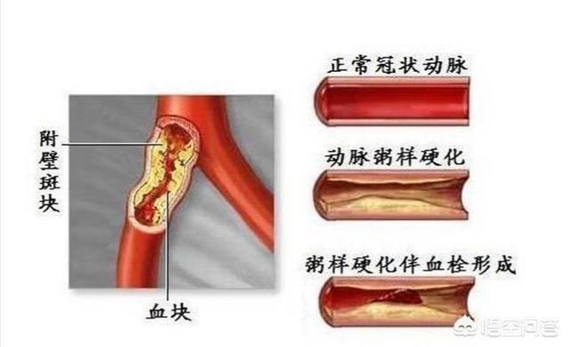 7莱姆病症状太容易被忽视:高血脂有哪些先兆症状，如何降低血脂？