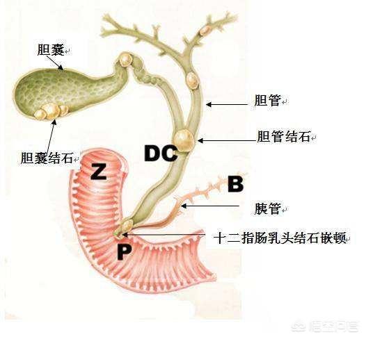 胆总管结石的症状是什么:大家对胆管结石了解多少？得了这个病治疗有什么好的建议吗？