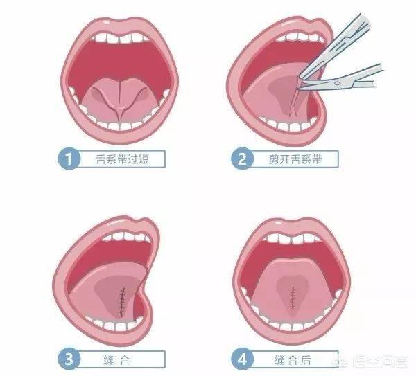 头条问答 - 宝宝舌系带短,怎么办?(4个回答)