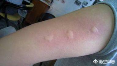蚊子咬人和血型有关系吗，蚊子咬了皮肤不肿怎么回事