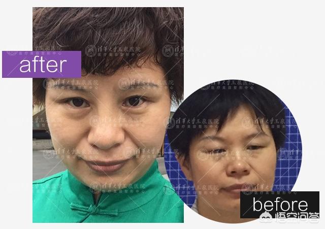 鼻头太大怎么变小,鼻头肥大，该如何提升鼻子美感？