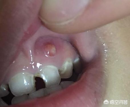 孩子得了牙龈炎怎么办:牙龈炎疼痛难忍怎么办 五岁小孩牙龈经常长脓包，该不该挑破？怎么办？