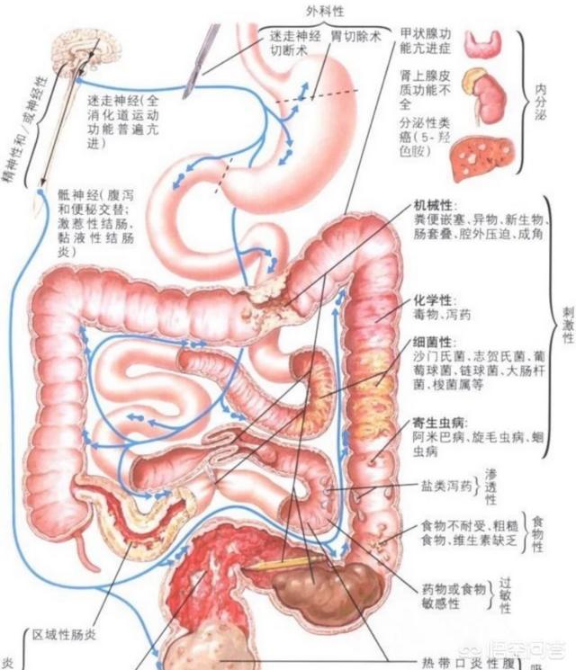 肠梗塞会腹泻:拉肚子的根本原因是什么？ 肠梗阻会腹泻吗