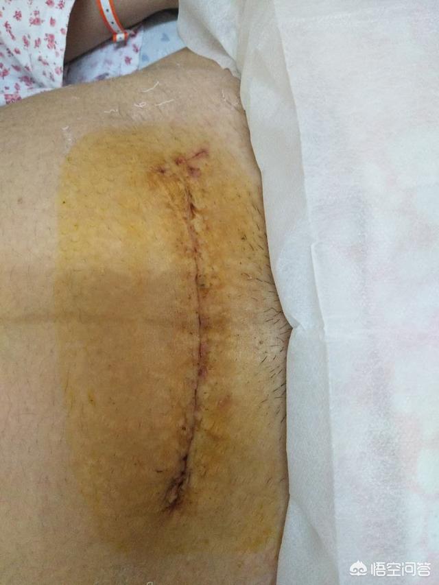 头条问答 - 剖腹产横切好还是竖切好?两者有什么区别?