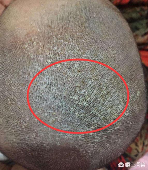 头条问答 - 婴儿的头垢带出了胎毛,以后还会有毛发生长吗?(9个回答)