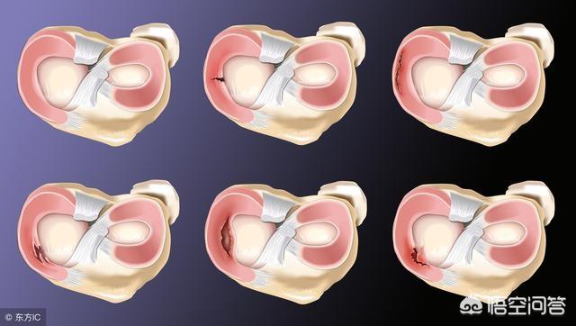 半月板损伤症状:半月板损伤症状的表现 半月板损伤后应注意哪些问题？