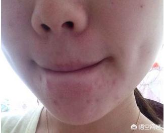 脸下巴长疙瘩怎么回事:下巴长了个疙瘩,一摸就疼,怎么回事 下巴上长疙瘩是怎么回事？应该怎么调理？