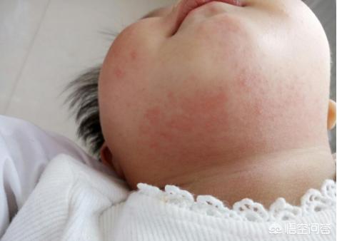 如何鉴别孩子起的是湿疹还是痱子，为什么有的宝宝身上忽然起了红点点