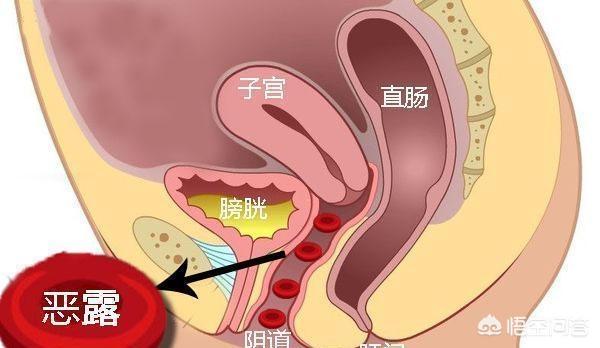 盆腔炎就一直流血吗?盆腔炎会一直流血吗