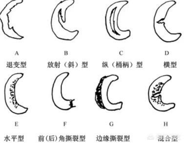 悟空问答 膝盖半月板撕裂 还能恢复吗 多久才能恢复 21个回答